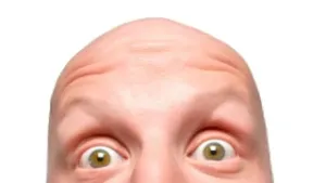 Waarom worden de meeste mannen kaal?