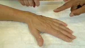 Een eeltachtige vergroeiing 