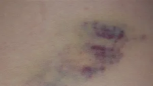 Een bloeduitstorting onder de huid