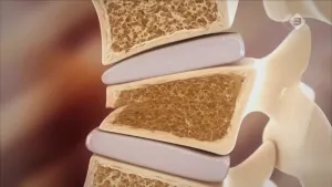 Botontkalking