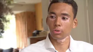 Een huidziekte waardoor je pigment verliest