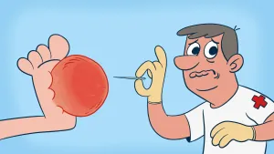 Tekening, cartoonachtig, van een voet met enorme rode blaar erop en arts die deze gaat doorprikken met een naald.
