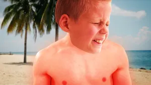 Foto van een door de zon verbrand jongetje dat pijn heeft op een strand met palmen.