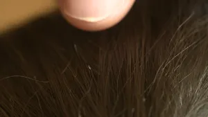 Foto van het haar van iemand waarin een hoofdluis te zien is.