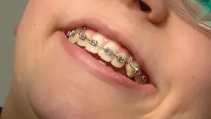 Een foto van een gezicht van dichtbij genomen. De lachende, open mond is zichtbaar. Op de tanden is een slotjesbeugel geplaatst, om scheve tanden recht te zetten. Het zijn kleine metalen stukjes op de tanden, die vastzitten aan één metalen draad. 