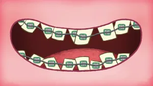 Hoe werkt een beugel?